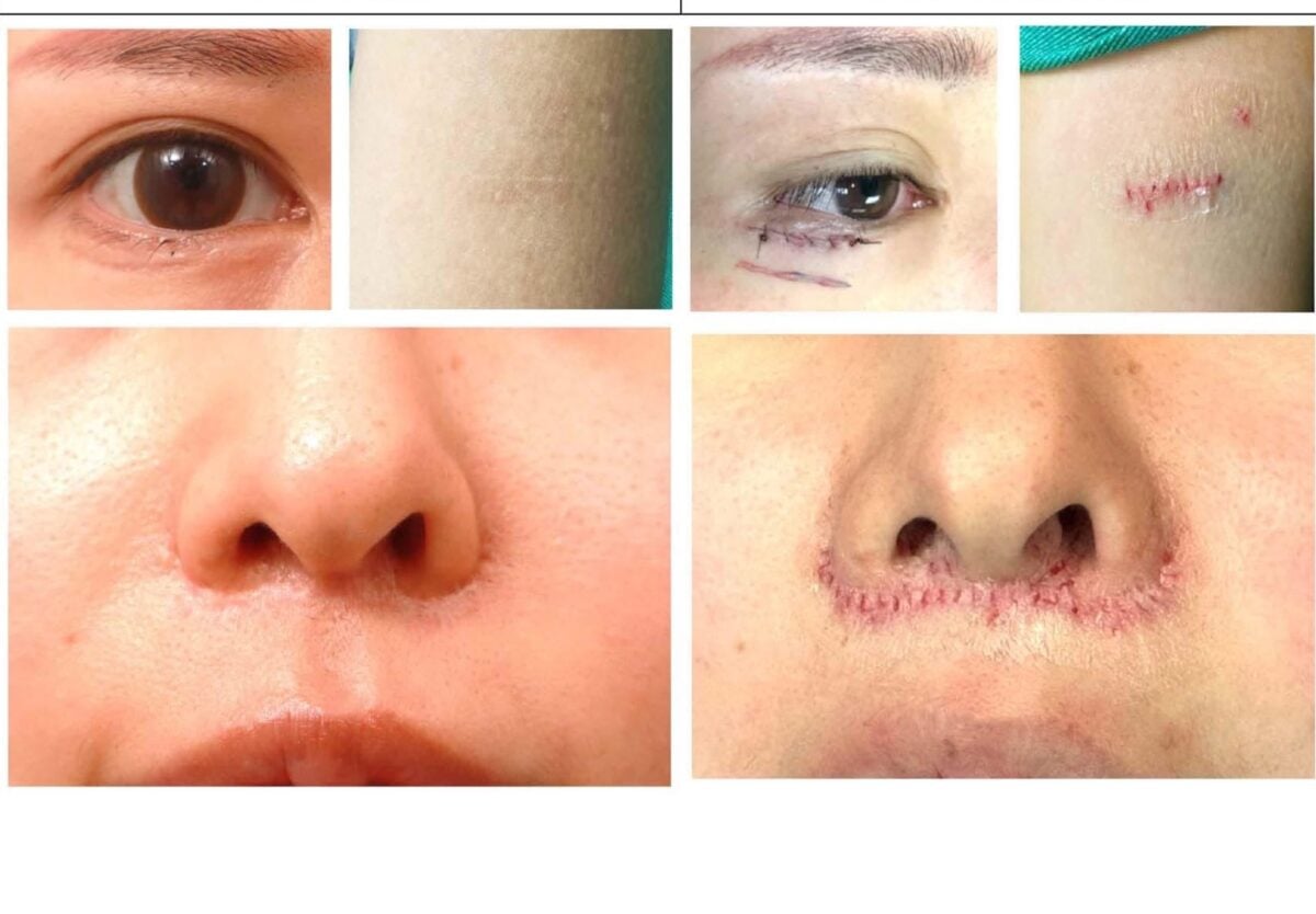 東京、京都患者接力來台　台灣白疤醫療技術吸引日本目光